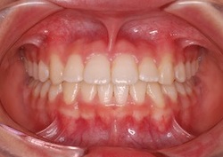 早期治療により非抜歯にて治療が完了できた小児の叢生(ガタガタの歯並び)症例
