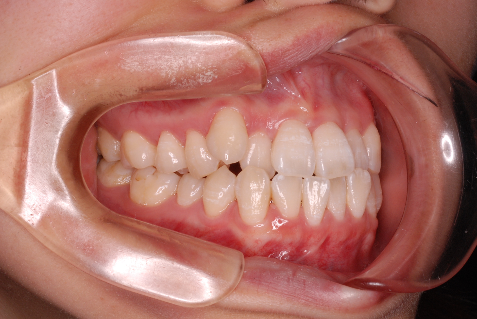 リンガルブラケット矯正(見えにくい矯正)で治療した成人の叢生(ガタガタの歯並び)症例