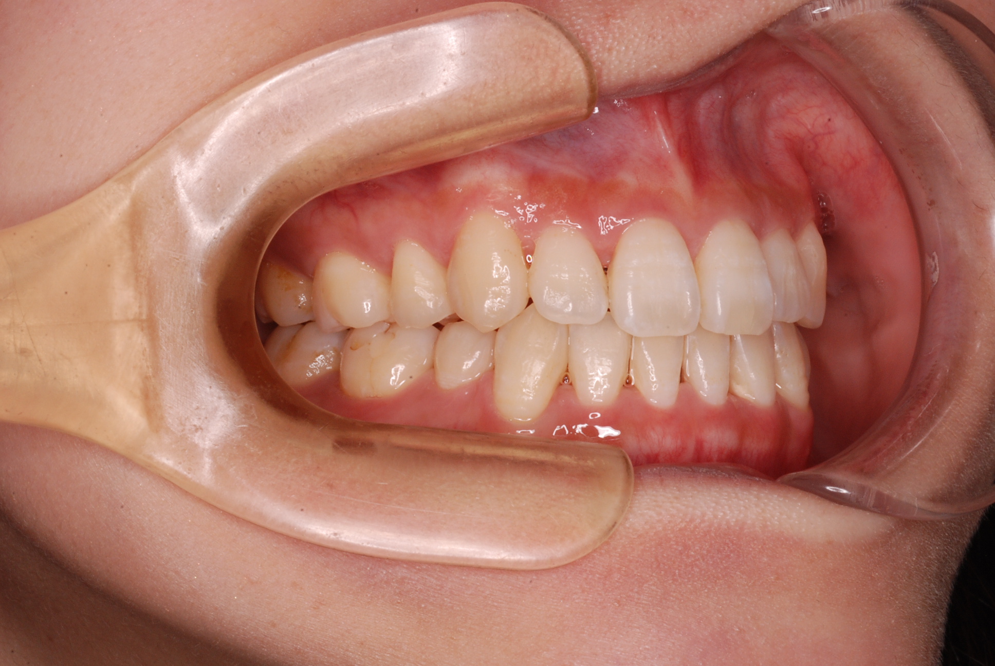 リンガルブラケット矯正(見えにくい矯正)で治療した成人の叢生(ガタガタの歯並び)症例