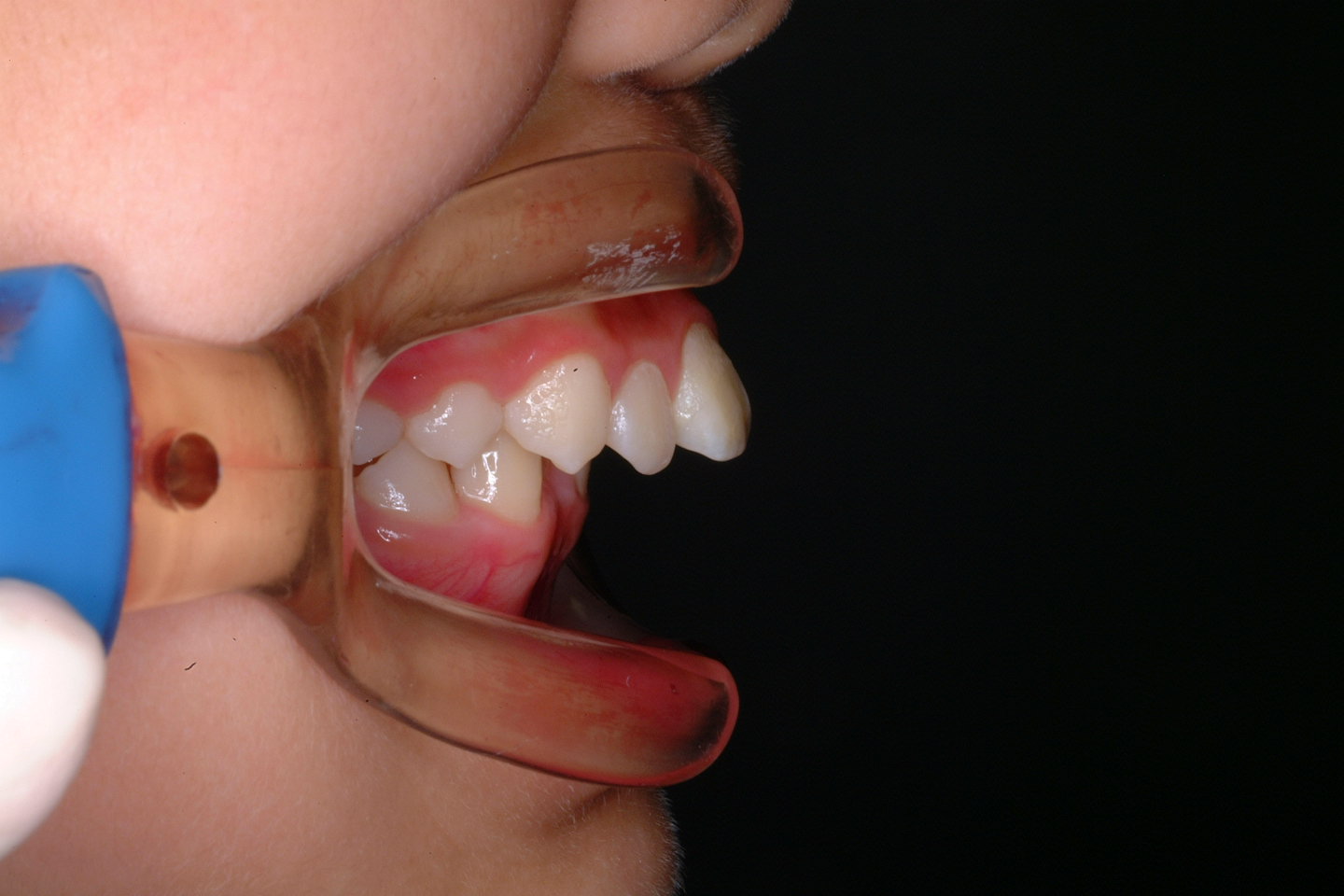 上顎骨の成長コントロールを行うことで前歯の後退量が多くとれた上顎前突(出っ歯)の治療例