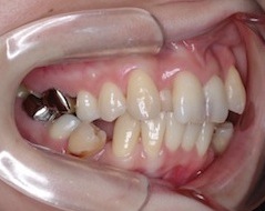 変則的な抜歯にて治療した成人女性のガタガタの歯並び(叢生)治療例