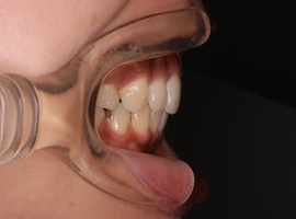 インプラントアンカー(矯正用ミニススクリュー)を用いて前歯の後退を行った治療例。