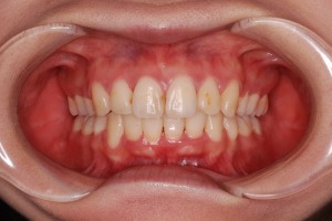20代の上下顎前突症例(ガタガタの歯並びをともなう)