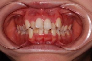 20代の上下顎前突症例(ガタガタの歯並びをともなう)