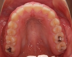 非抜歯で治療を行った重症の叢生症例(ガタガタの歯並び)