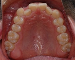 リンガルブラケット（見えない矯正）にて治療した叢生(ガタガタ)の症例