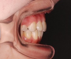 リンガルブラケット(見えない矯正)で治療した重度の上顎前突症例