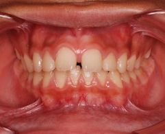 空隙歯列(隙っ歯)をともなう上顎前突症（出っ歯）