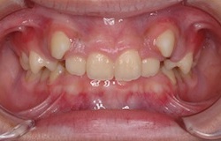 叢生(ガタガタの歯並び)をともなう過蓋咬合(深い咬み合わせ)の治療例