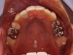 リンガルブラケット(見えない矯正)にて治療を行った成人の叢生症例(ガタガタの歯並び)