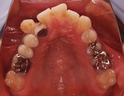 リンガルブラケット(見えない矯正)にて治療を行った成人の叢生症例(ガタガタの歯並び)