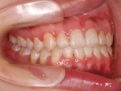 埋伏歯（2本）の牽引治療症例