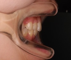 成長期に上顎骨の成長コントロールを行ったシビアな骨格性上顎前突症例