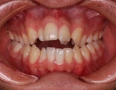 非抜歯にて治療を行った叢生と交叉咬合をともなう重度の開咬症例