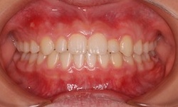 埋伏犬歯を有する空隙歯列(隙っ歯)の治療例