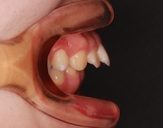 成人男性の上顎前歯前突症例