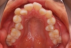 リンガル矯正（裏からの見えない矯正）で治療を行った叢生を伴う開咬症例