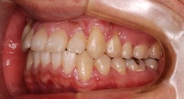 上顎犬歯が方向異常と歯牙腫により埋伏していた叢生症例