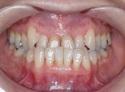 前歯部に叢生をともなう骨格性反対咬合の治療症例