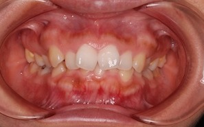 非抜歯・エナメルストリッピング法にて矯正治療を行った成人の叢生治療例