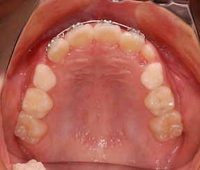 早期治療により非抜歯にて叢生の改善を行った症例