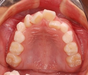早期治療により非抜歯にて叢生の改善を行った症例