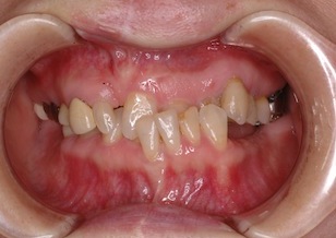 多数歯欠損をともなう口唇口蓋裂に起因する反対咬合の治療例。