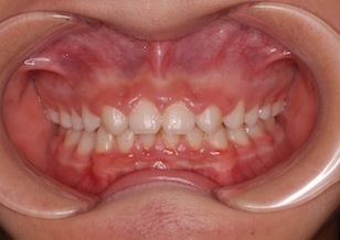 4本の先天欠如歯を認める過蓋咬合症例。