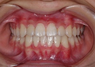 側方歯部に開咬をともなう反対咬合（受け口）症例。