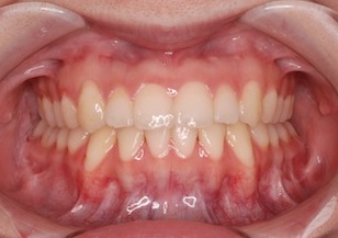 顎変形症に起因する開咬症の治療例。