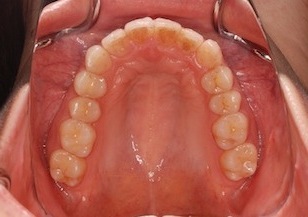 非抜歯にて矯正治療を行った叢生(ガタガタの歯並び)症例