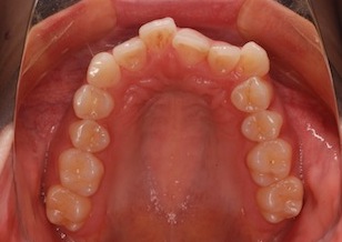 非抜歯にて矯正治療を行った叢生(ガタガタの歯並び)症例