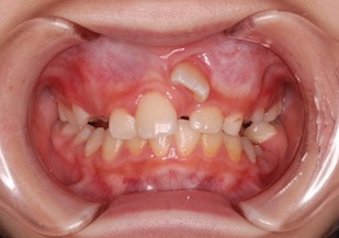 早期治療により永久歯を抜かずに完了した叢生症例