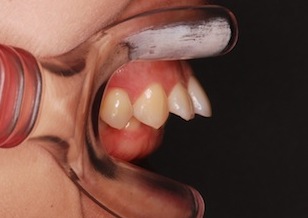 臼歯部に交叉咬合を認める成人の上顎前突症