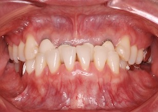 下顎臼歯部に欠損歯を有する前歯部反対咬合症例。