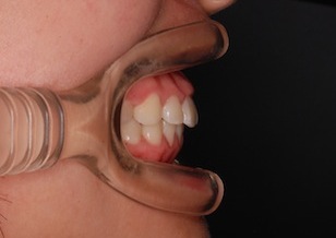 成長期の骨格性上顎前突（出っ歯）の治療例。(非抜歯)