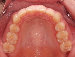 上顎前歯の前突をともなう叢生症例