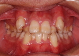 上下顎歯列に重度の叢生を認める成人男性症例
