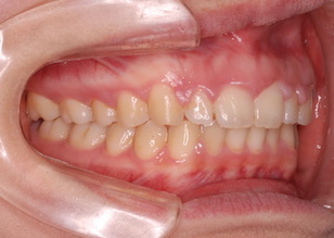 上顎歯列に空隙（隙っ歯）が7カ所、下顎歯列に空隙を4カ所を認める症例。