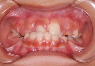 非抜歯で治療を行った成長期の反対咬合(受け口)症例。