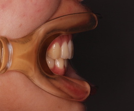 リンガルブラケットにて治療を行った、先天欠如歯をともなう上顎前突症例