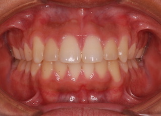 ペンンデュラムアプライアンスを用い、非抜歯にて矯正治療を行った埋伏歯をともなう叢生症例