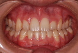 小臼歯4本抜歯にて矯正治療を行った重度の叢生(ガタガタの歯並び)症例。