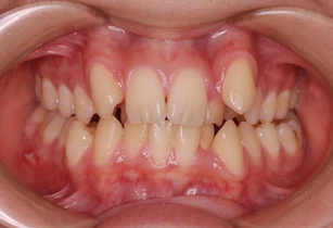 小臼歯4本抜歯にて矯正治療を行った重度の叢生(ガタガタの歯並び)症例。