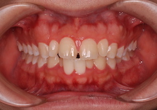 成人の叢生をともなう反対咬合（受け口）症例