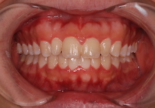成人の叢生をともなう反対咬合（受け口）症例