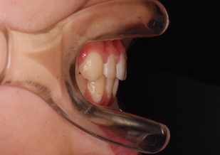 叢生をともなう上顎前突症例
