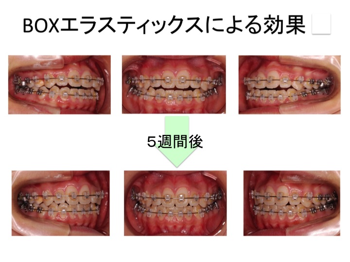 歯科矯正 顎間ゴム ゴムかけ 歯並び エラスティック ワイヤー インビザライン