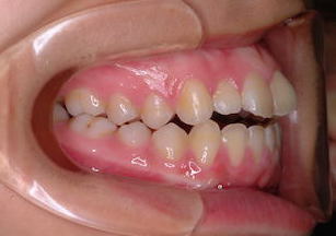 舌癖のコントロールを行い非抜歯にて矯正治療を行った開咬症例
