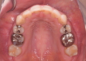 小臼歯抜歯にて治療を行った叢生症例